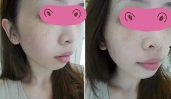 激光去雀斑视频,高效美肤新选择，见证肌肤蜕变之旅